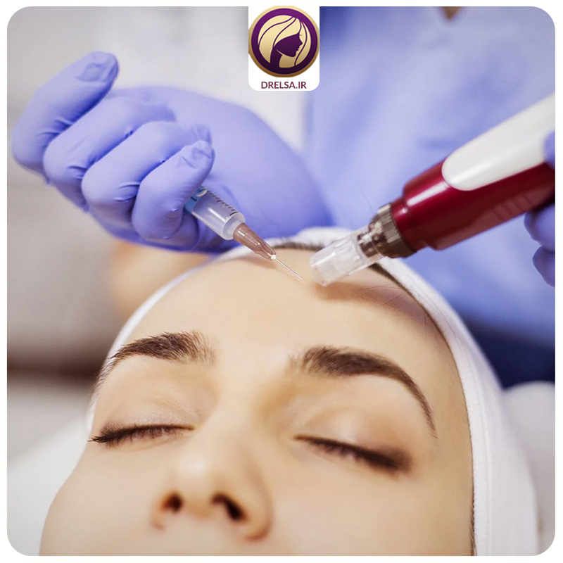 مزوتراپی صورت